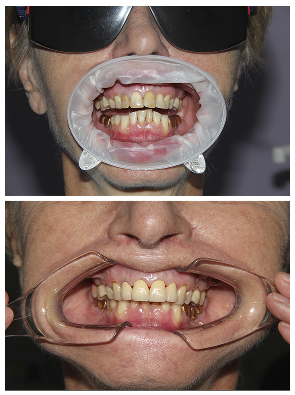 Жалобы на дисколорит фронтальной группы зубов и неудовлетворительную форму зубов