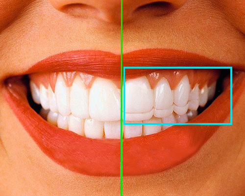 Удлинение зубов: показания и методы